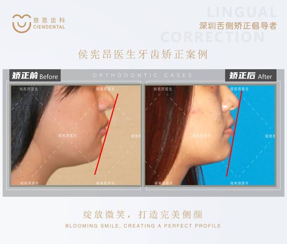 成都为什么24岁做牙齿矫正效果更好