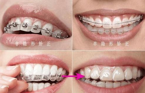 成都30多岁还能矫正牙齿吗？过来人真实经验分享