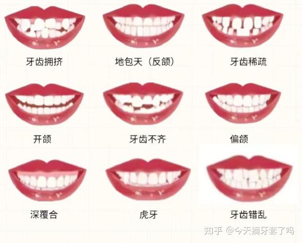 牙齿正畸费用一般多少_30多岁正畸牙齿_牙齿正畸最佳年龄