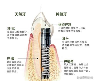 成都深圳缺牙修复：镶牙与种植牙到底哪个更省钱？