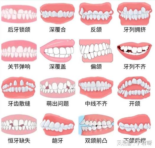 成都儿童牙齿矫正一般价格多少?带娃整牙到底花几万