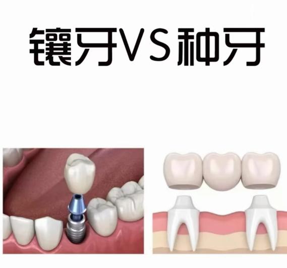 成都长沙种牙和假牙到底选哪个?看完这篇别再花冤枉钱