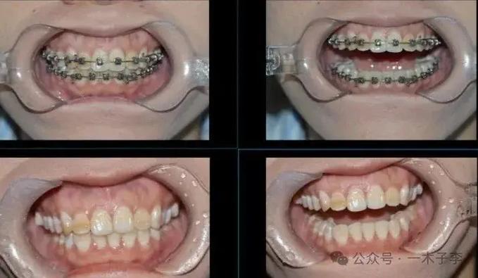 成都30岁矫正牙齿有什么危害?把坑说透了再决定