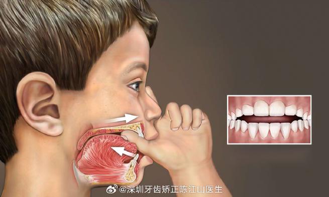 成都深圳孩子地包天几岁治最好？牙医揭秘黄金期