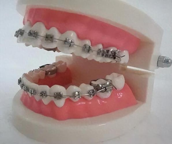 成都35岁矫正牙齿还来得及吗?真实体验告诉你