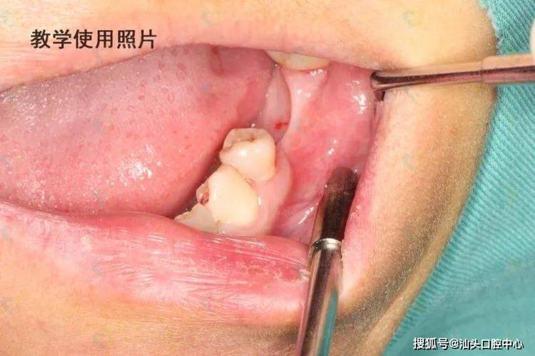 成都没有牙骨也能种牙？医生说实话