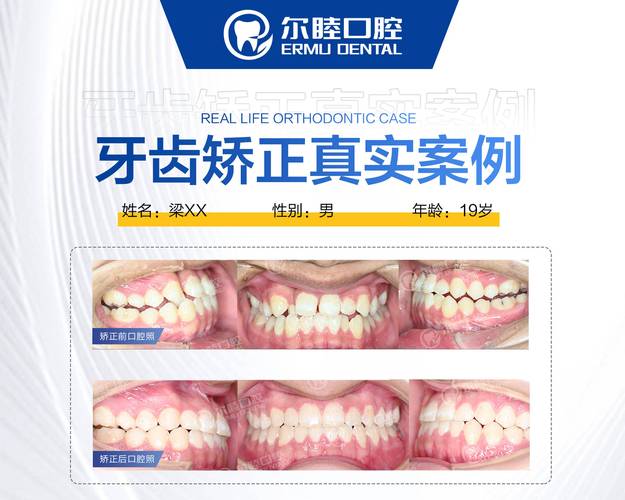 成都深圳牙齿矫正要花多少钱？