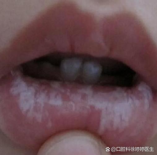 成都儿童口腔有白色黏膜到底严不严重