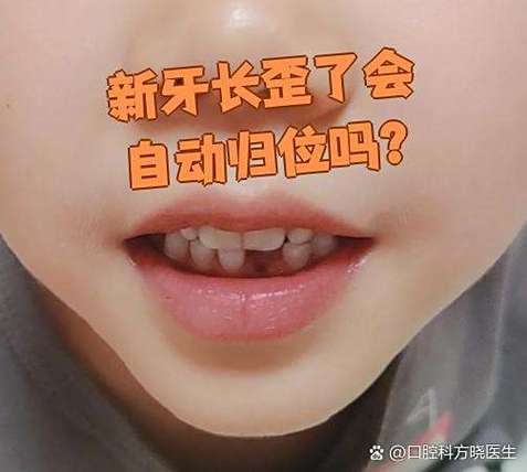 成都六岁孩子门牙长歪先别慌 看这几种矫正办法