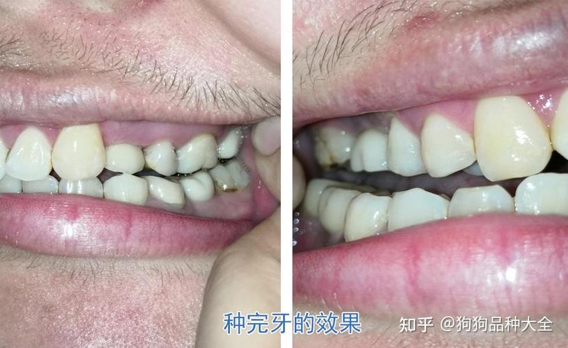 成都赤峰种植牙哪里好 公立三甲靠谱推荐