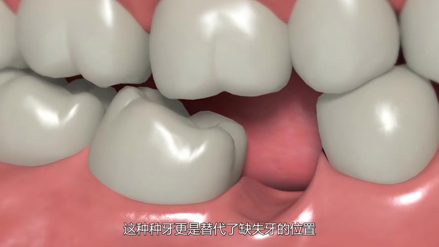 成都种牙到底疼不疼？一篇说清楚植牙真相