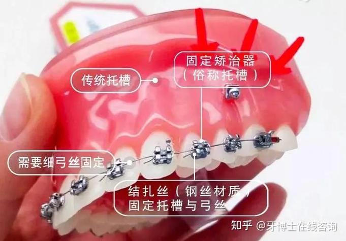成都深圳龙岗做隐适美矫正到底要花多少钱？