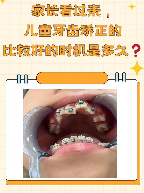 成都8岁做牙齿矫正早不早？看情况，地包天要趁早