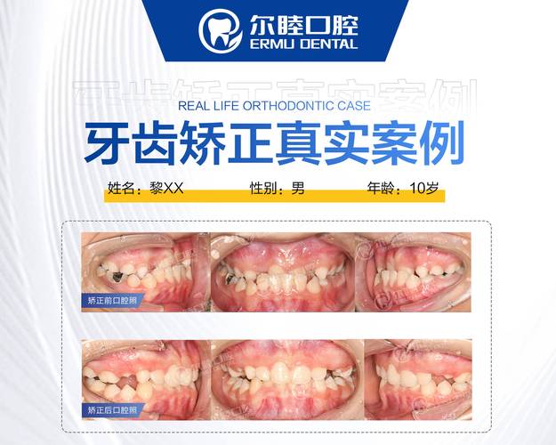 牙齿矫正可以做第二次吗_牙齿矫正后可以去别的地方弄吗_深圳30岁还能做牙齿矫正吗