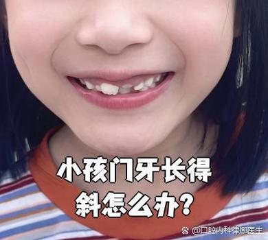 成都深圳孩子换牙门牙乱长怎么办？专业干预攻略