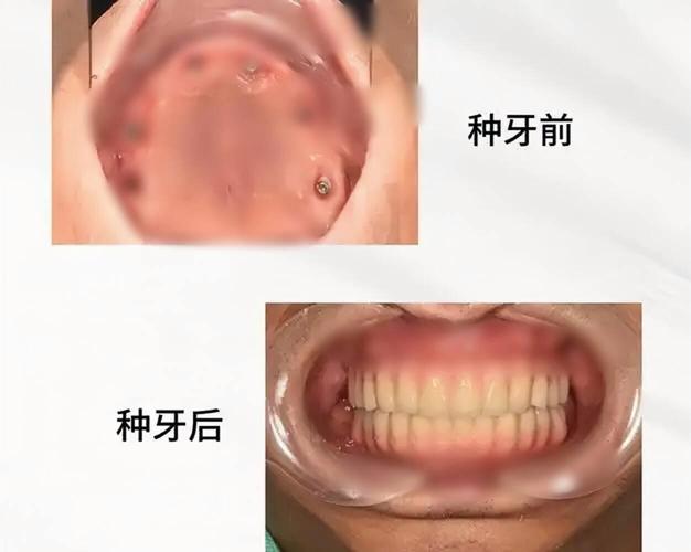 成都70多岁还能种牙吗？种牙风险大不大？