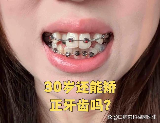 成都30岁龅牙怎么快速矫正？