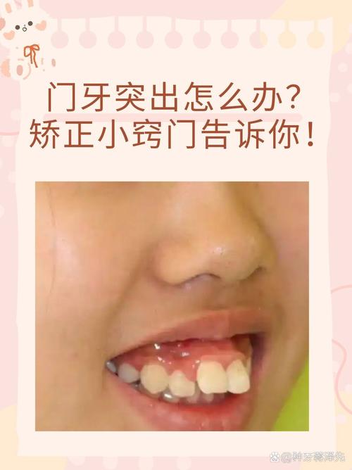 成都10岁孩子门牙突出，医生揭秘：抓住黄金期，这个最快