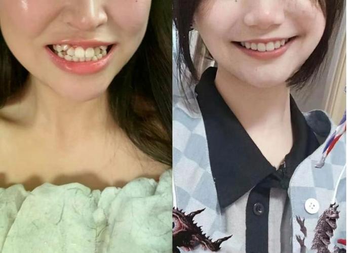 成都36岁还能矫正牙齿吗 成人正畸的真相与风险