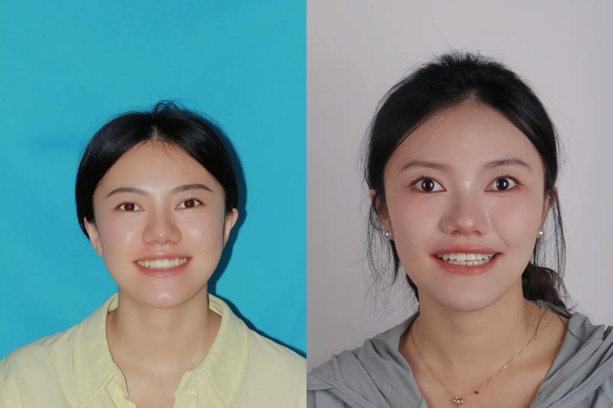 成都20岁矫正牙齿晚不晚？过来人告诉你真实答案