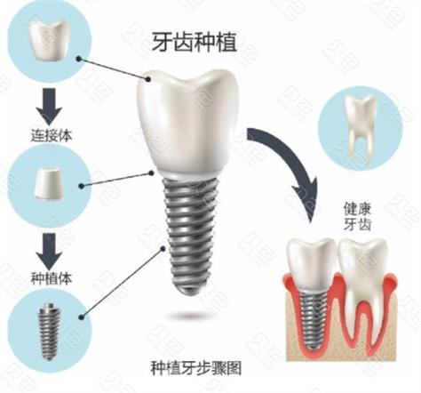 成都九江威高种植牙多少钱一颗2026最新价格