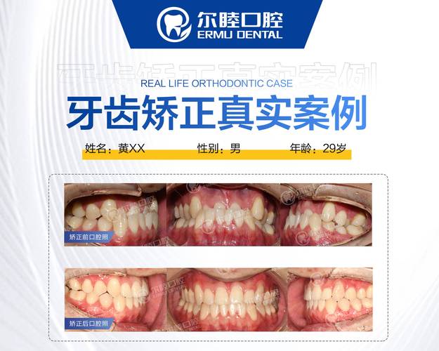 成都深圳南山做MRC矫正哪家医院靠谱？