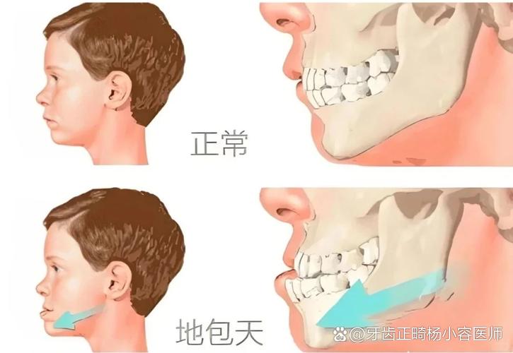 成都12岁小孩能做牙齿矫正吗？别等换完牙才后悔