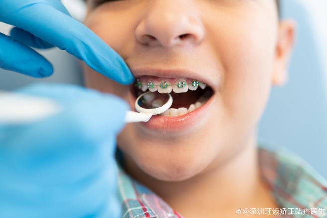 成都8岁孩子门牙龅牙矫正方法 儿童早期干预怎么做