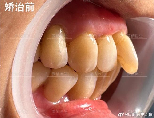 成都60岁还能做牙齿矫正吗