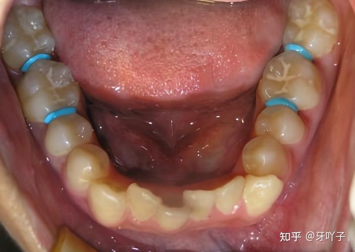 成都玉林牙齿矫正效果怎么样？看完这篇就心里有数了