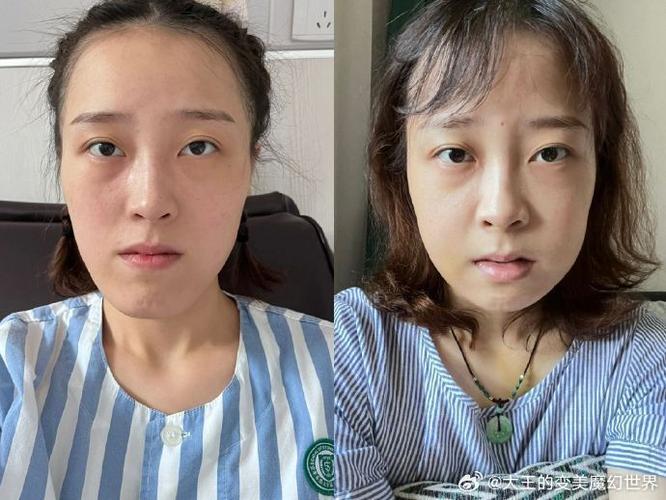 18岁女孩地包天牙能矫正吗_地包天能矫正四个牙齿吗_矫正地包天去医院还是去牙所