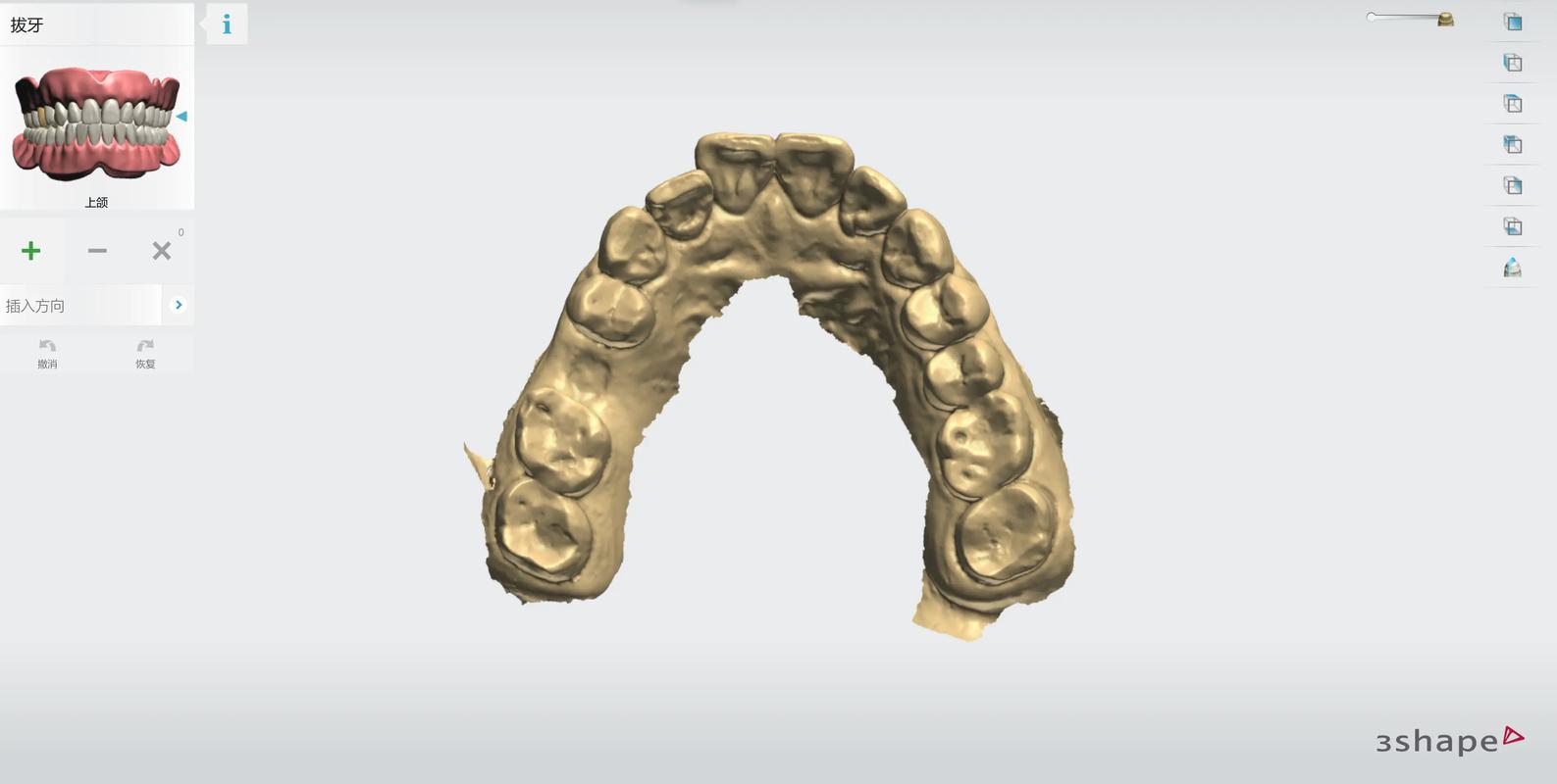 成都3D导板数字化种植牙：告别传统盲种，种牙更精准更安心
