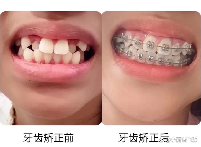 成都15岁牙齿不齐怎么办 专家说三种矫正方式哪种最适合你