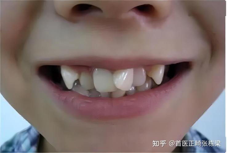 成都深圳儿童地包天最佳矫正年龄是多少?别等换牙误了大事