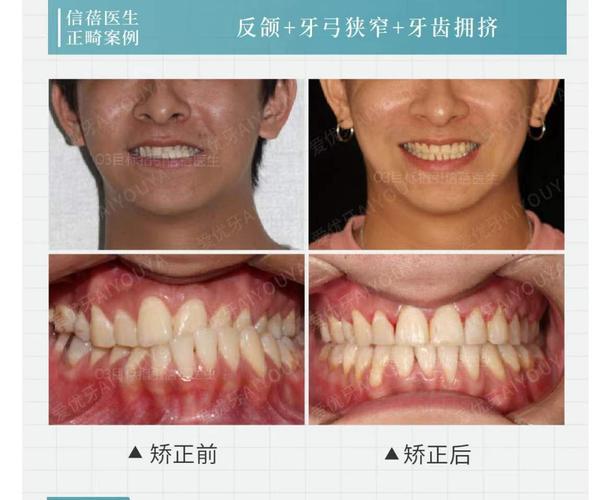 成都深圳中学生牙齿矫正优惠活动真的靠谱吗?