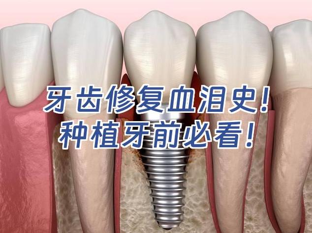 成都种植牙失败了怎么办 修复费用要多少才合理