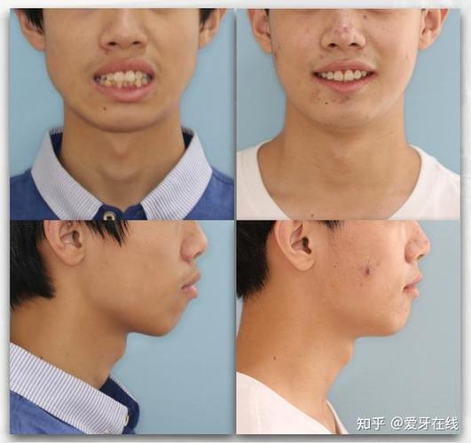 成都呼和浩特牙齿矫正靠不靠谱？效果真实揭秘