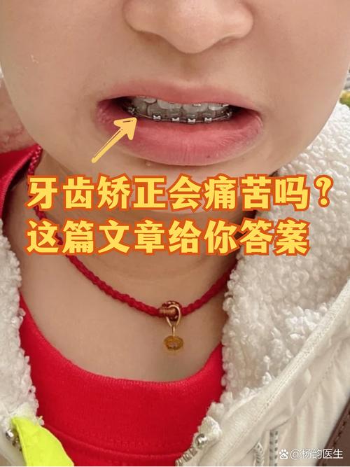 成都19岁做牙齿矫正晚不晚 过来人告诉你真实经历