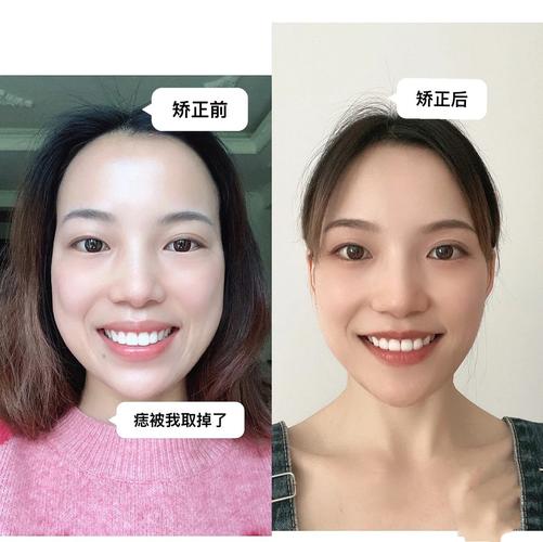 成都成年人牙齿矫正还来得及吗