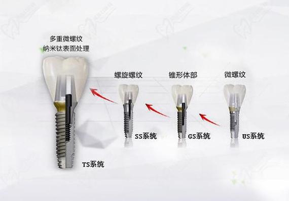 成都唐山韩系奥齿泰种植牙2026最新费用一览