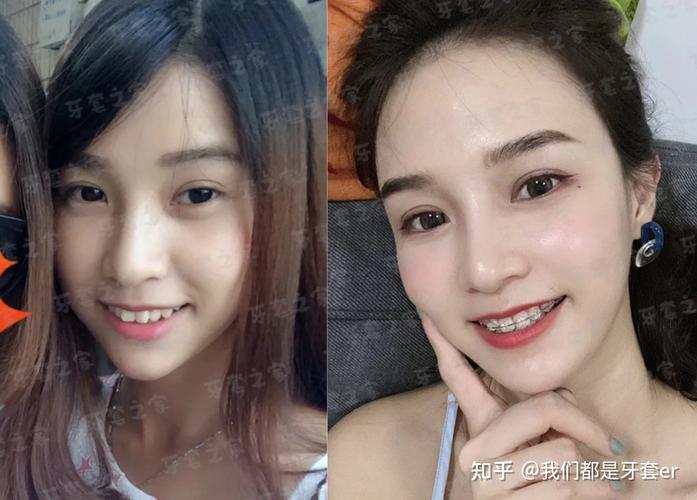 成都43岁矫正深覆合牙齿要多少钱?从检查到摘牙套费用全掰扯清楚