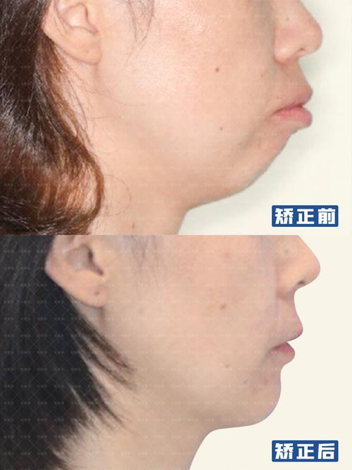 成都矫正牙齿能改善下巴后缩吗？3个关键问题正畸医生一次说清