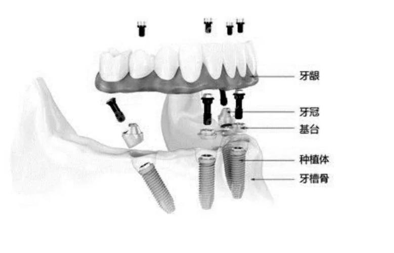 成都半口种牙费用不固定 一颗大概多少钱