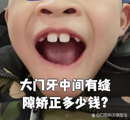 成都保定矫正牙齿费用一览：一般多少钱？价格明细来了