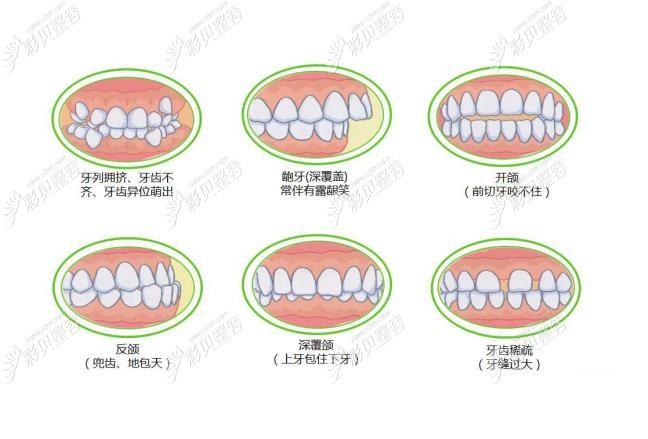成都南阳牙齿矫正多少钱?2026最新价格大公开