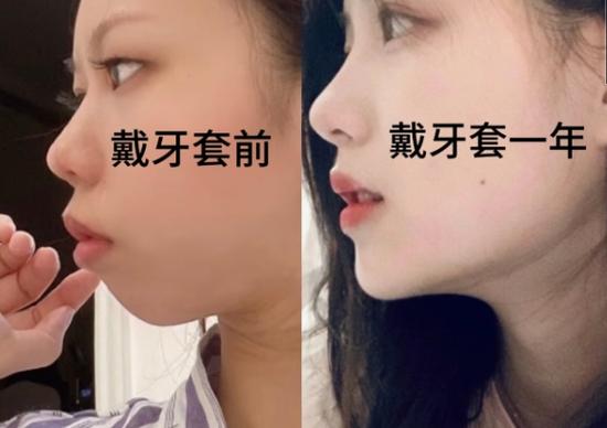 成都郴州做牙齿矫正哪家好?看完这篇不踩坑
