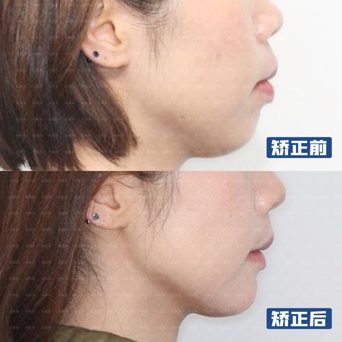 成都30多岁做牙齿矫正晚吗?成人正畸的真相赶紧看