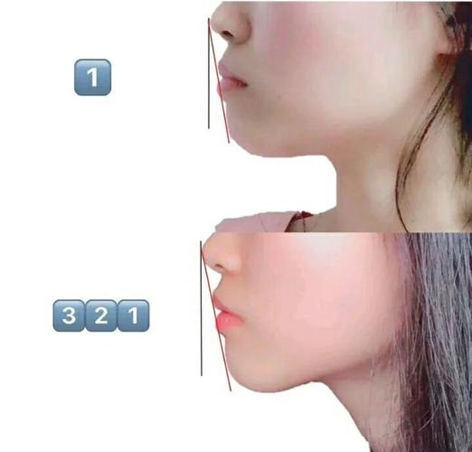 成都34岁做龅牙矫正还来得及吗？我的真实感受