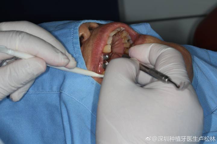 成都80岁还能种牙吗？医生说只要满足这个条件就能做