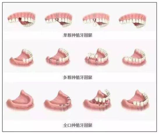 成都半口种植牙全过程要多久？疼不疼？一步步讲清楚